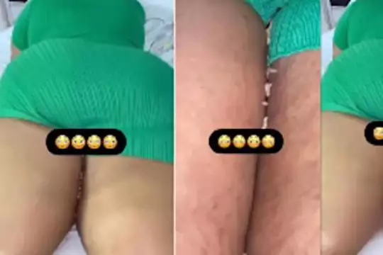 UNBELIEVABLE: Lady Suffers Maggot Infestation After Butt Enlargement Surgery