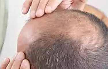 Facing hair fall or going bald? Try It Now