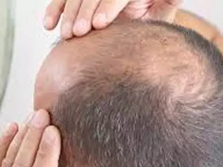 Solve Your Hair Loss Problem In As Few As Thirty Days. Solve Your Hair Loss Problem In As Few As Thirty Days.