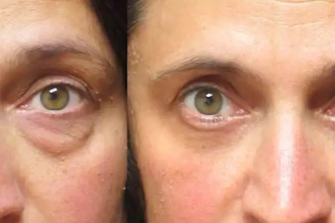 Pessoas com bolsa nos olhos devem ler isto Pessoas com bolsa nos olhos devem ler isto