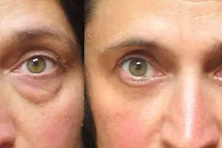 Como corrigir as bolsas nos olhos (Faça isso todos os dias) Como corrigir as bolsas nos olhos (Faça isso todos os dias)