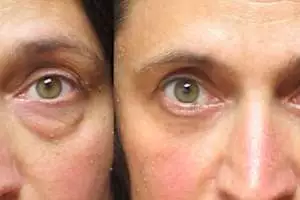 Como concordar as bolsas nos olhos (Faça todos isso os dias)
