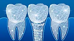 1 Day Dental Implants in Minneapolis Are Becoming A Reality.