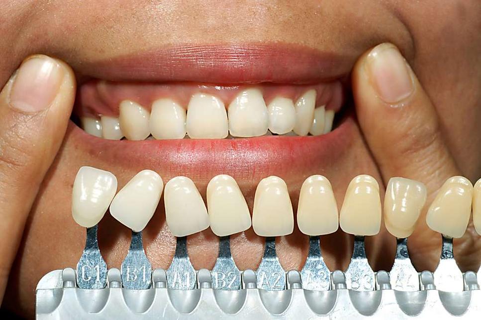 The Cost Of One Day Full Mouth Dental Implants in 2023 Might Surprise You
