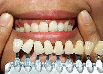 Full Mouth Dental Implants in Johannesburg in 2021 May Be More Affordable Than You Think