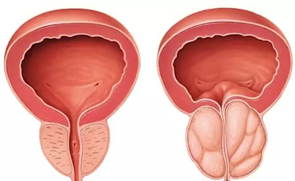 Top US Men's Surgeon: Do This Once Daily To 'Shrink' Enlarged Prostate