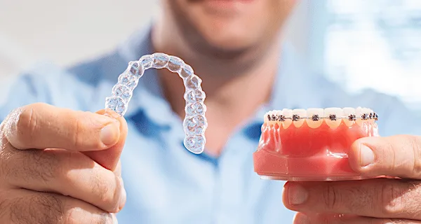 The Cost of Invisible Teeth Aligners in Rahim Yar Khan Might Surprise You The Cost of Invisible Teeth Aligners in Rahim Yar Khan Might Surprise You