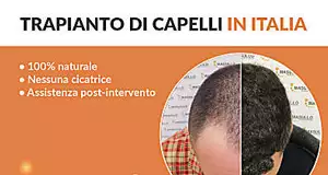 Il trapianto di capelli per chi non vuole compromessi, in Italia