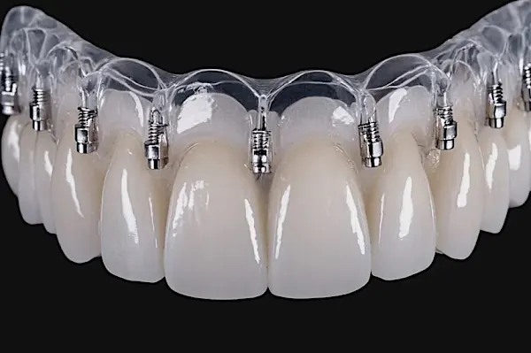 Εμφυτεύματα Δοντιών σε Δημόσια Νοσοκομεία στην Ελλάδα το 2025 Εμφυτεύματα Δοντιών σε Δημόσια Νοσοκομεία στην Ελλάδα το 2025