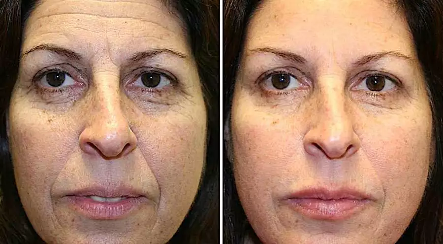 Botox é passado! Isto vai melhorar aspecto de rugas na pele. Confira!