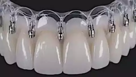 台灣植牙新趨勢:技術創新與價格透明化 台灣植牙新趨勢:技術創新與價格透明化