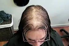 Mulher trata calvicie com composto que faz nascer cabelo e choca especialistas
