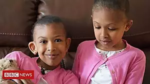 Conjoined twins meet surgeons who separated them