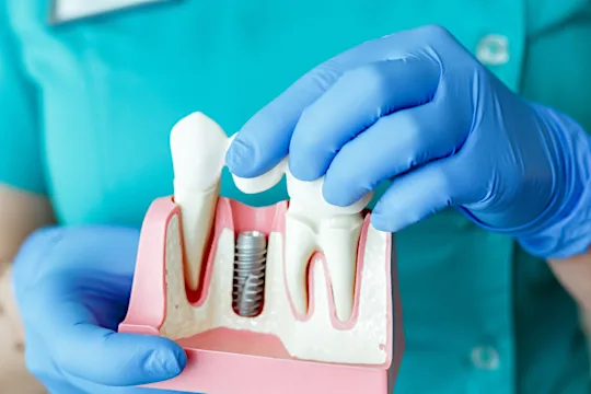 Ahmedabad: The Cost of Dental Implants Might Surprise You Ahmedabad: The Cost of Dental Implants Might Surprise You