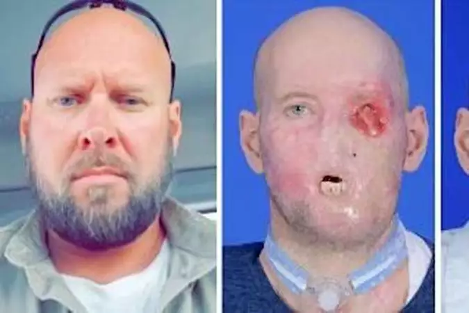 米国で世界初の眼球・顔移植報告 事故でけが、1年定着も視力なし 米国で世界初の眼球・顔移植報告 事故でけが、1年定着も視力なし