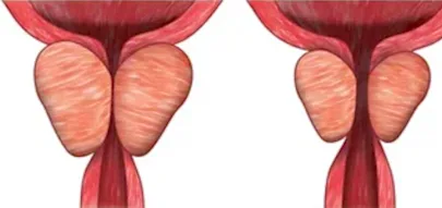 Enlarged Prostate Has Nothing To Do With Age: Just Stop Doing This One Common Thing