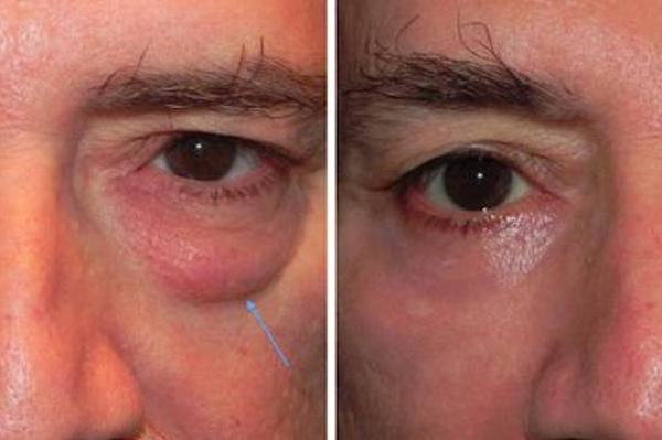 Le occhiaie fanno invecchiare di 10 anni: questo trucco aiuta Le occhiaie fanno invecchiare di 10 anni: questo trucco aiuta