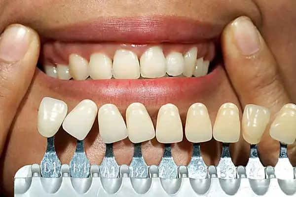 Full Mouth Dental Implants in Turkey! The prices might surprise you