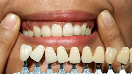 ¡Implantes dentales de boca completa en Turquía! El costo puede sorprenderte