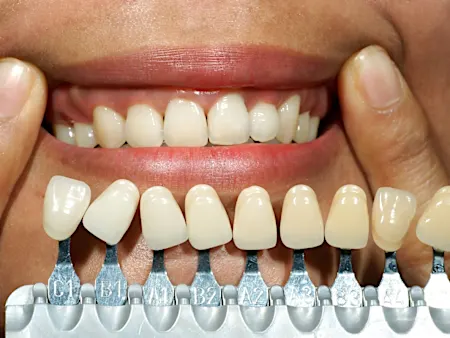 Full Mouth Dental implant Prices In Turkey Might Surprise You