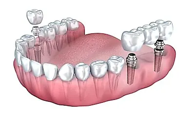 Dental Implants May Be Cheaper Than You Think: See Prices
