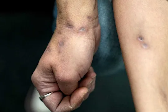 Xylazine: Flesh-rotting ‘zombie’ drug claims first victim in Europe