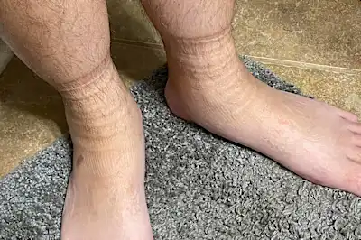 My Feet Were a "Prison of Fire," Until a Pain Expert Showed Me This My Feet Were a "Prison of Fire," Until a Pain Expert Showed Me This