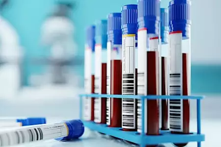 Users of Blood-Based MRD Testing for Solid Tumors Split on Approaches, Applications