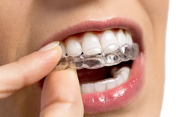 Cost Of Invisible Braces In Pontianak Might Surprise You