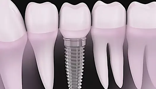 O que são implantes dentários sem parafusos e quanto custam para idosos? olhar! O que são implantes dentários sem parafusos e quanto custam para idosos? olhar!