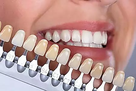 Quanto custa para implantar todos os dentes da boca? Os preços podem surpreendê-lo