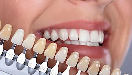 Costul implanturilor dentare din 2022 s-ar putea să te surprindă