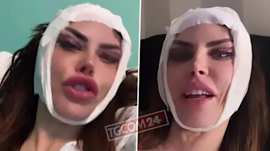 Guendalina Tavassi dopo l'intervento di chirurgia estetica: ecco cosa ha rifatto