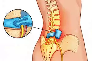 Pain Down Your Leg? Try This Simple 3-Second Sciatica Relief Trick