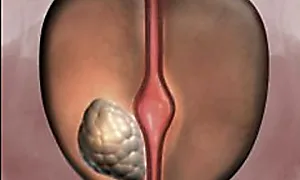 Urologist: Enlarged Prostate? Do This Immediately (Genius!)