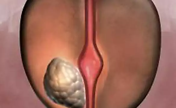 Urologist: Enlarged Prostate? Do This Immediately (Genius!)