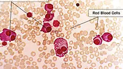 Here's what you need to know about multiple myeloma