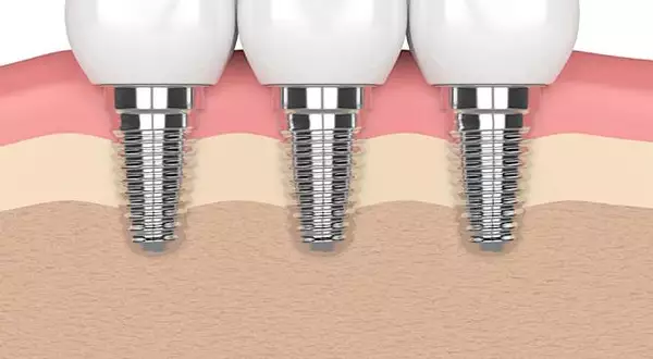 Os preços dos implantes dentários em 2020 podem surpreendê-lo