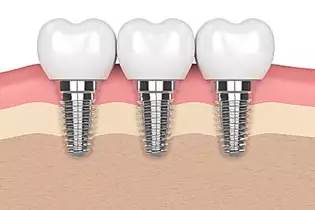 Here Is What Full Mouth Dental Implants Should Cost You in 2020