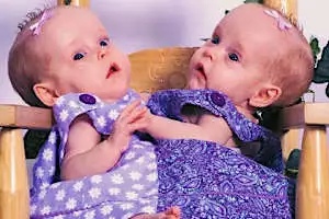 Conjoined Twins Defied The Odds And Survived Separation: Here They Are 16 Years Later