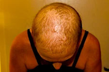 Ex careca recupera cabelo com composto que ativa células tronco do couro cabeludo