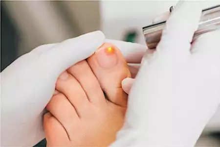 Θέλεις να αποκτήσεις άμεσα καθαρά νύχια χωρίς μύκητες;