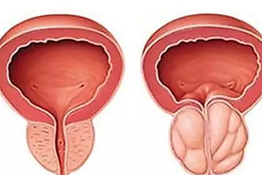 Urologist: Try This If You Have An Enlarged Prostate (Watch)