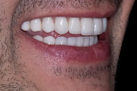 Add This To Your Toothpaste To Help Regrow Gums in a Few Days