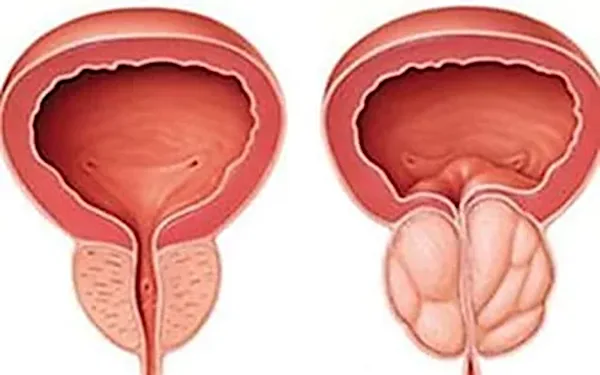 Κάντε το αμέσως εάν έχετε μεγεθύσει τον προστάτη (ρολόι)