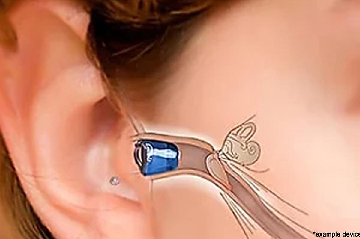 Wanted: People to Try Latest High-Tech Hearing Aids in Sydney