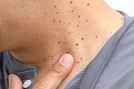 Do This Immediately If You Notice Skin Tags or Moles