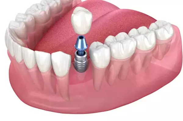 Εμφυτεύματα Δοντιών σε Δημόσια Νοσοκομεία Ελλάδα 2026 Εμφυτεύματα Δοντιών σε Δημόσια Νοσοκομεία Ελλάδα 2026