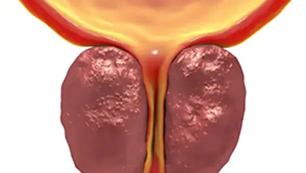 Urologist: Plenty of Men With An Enlarged Prostate Do Not Know About This Simple Solution