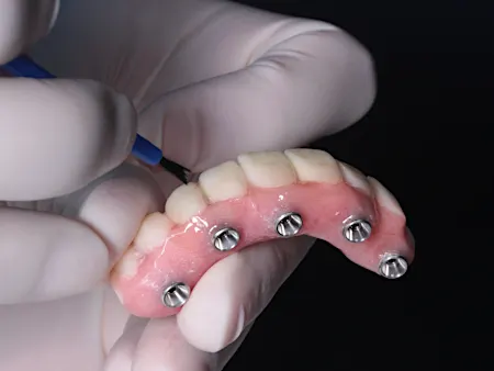 Here Is What Full Mouth Dental Implants Should Cost You in Dallas